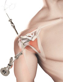 Arthroscopic Surgery